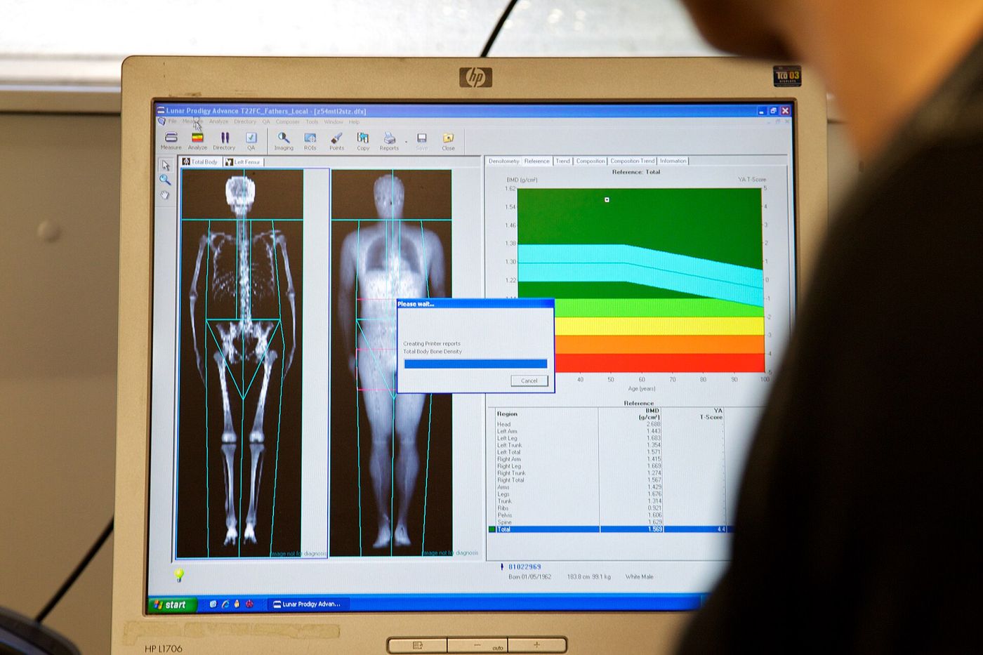 DEXA scan screen ALSPAC
